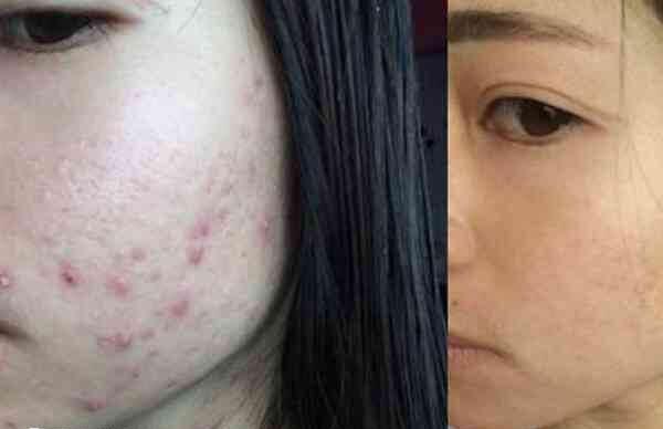 孕期脸上长痘怎么办