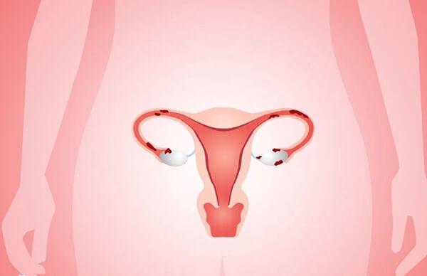 多囊卵巢症最佳的治疗办法是什么