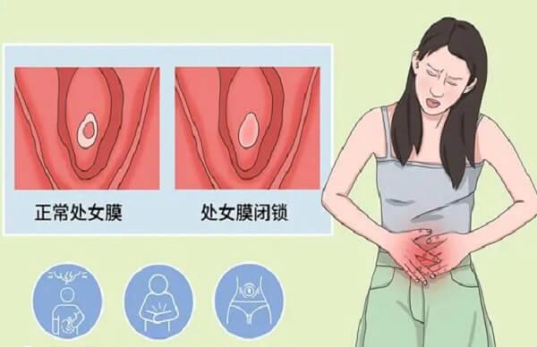 处女膜闭锁会不会影响怀孕