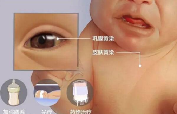 新生儿黄恒护理方法