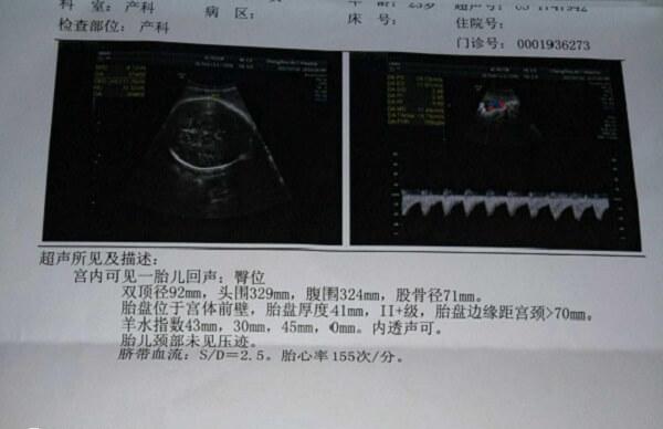 孕中期后壁臀位就是女孩