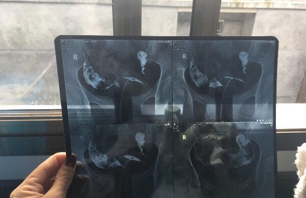 女性输卵管不孕治疗方式有哪些
