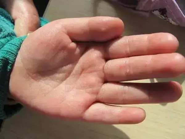 儿童手足口病的传染源有哪些