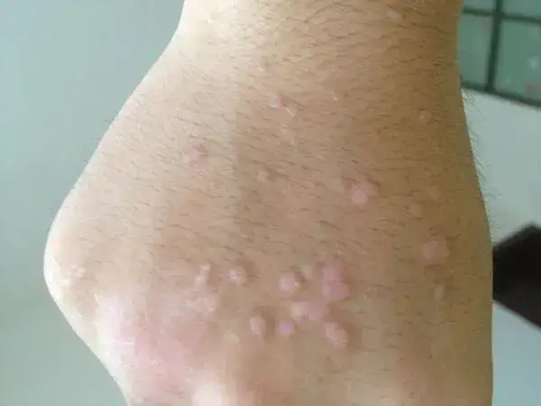 感染hpv病毒的症状有哪些