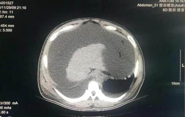 试管婴儿怀孕腹水的风险有哪些