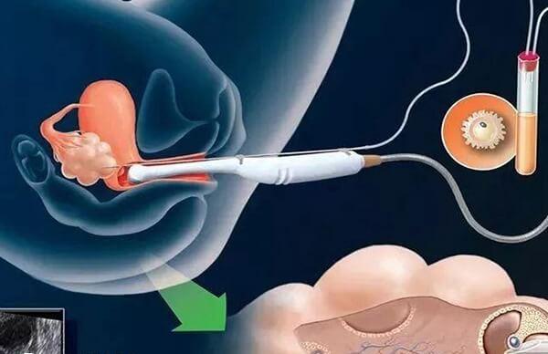 取卵是否必须要打麻醉药