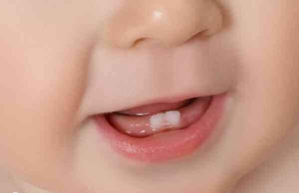 婴儿缺钙的10大表现有哪些