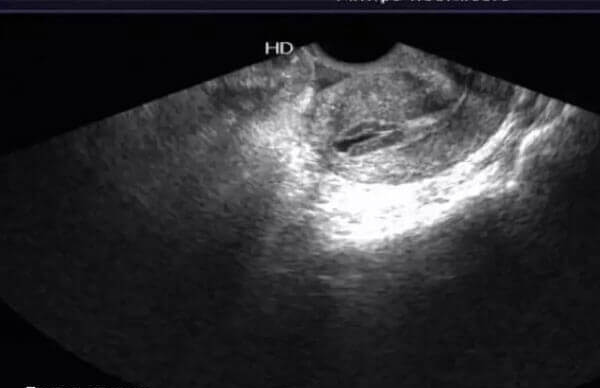 打促排针内膜变厚怎么办