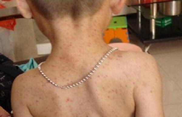 白血病初期小红点图片是什么样