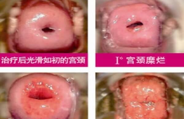 宫颈糜烂一二三度图片什么样