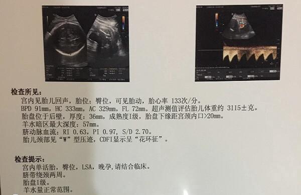 改变胎儿臀位的方法有哪些