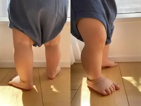 婴儿佝偻病的症状有哪些