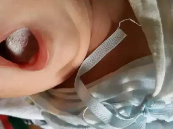婴儿鹅口疮和口腔溃疡有什么区别