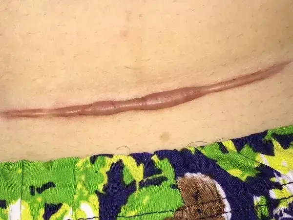 剖腹产多久可以同房