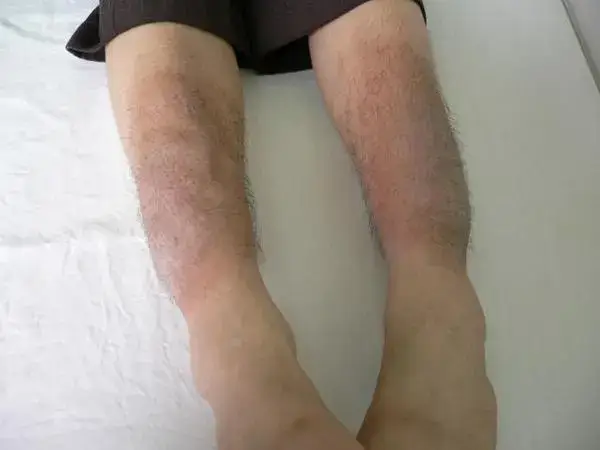 黄疸高对婴儿的影响有哪些