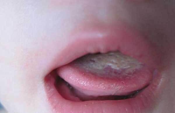 预防宝宝鹅口疮的方法有哪些