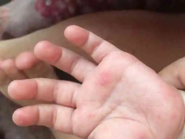 不建议打手足口疫苗的原因是什么