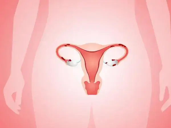 女性卵巢低反应适合的促排卵方案有哪些