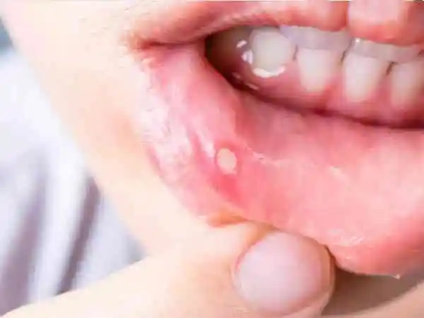 宝宝口腔溃疡要怎么办