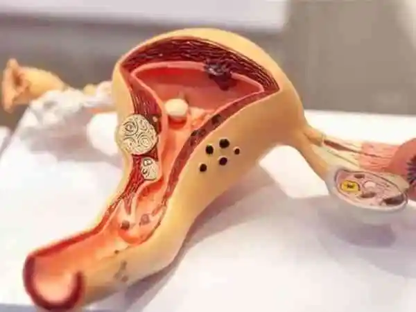 子宫腺肌症为什么要打降调针