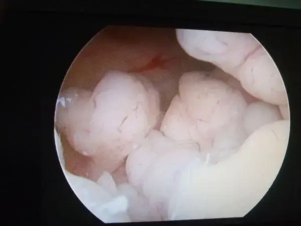 试管婴儿前宫腔镜检查疼不疼