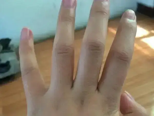 孕妇水肿怎么办