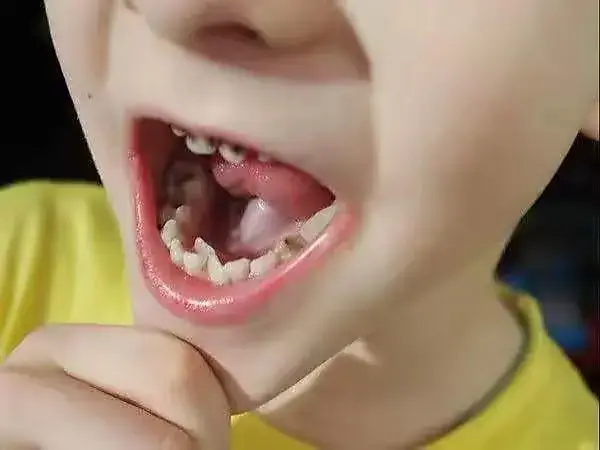 宝宝出牙晚是什么原因导致的