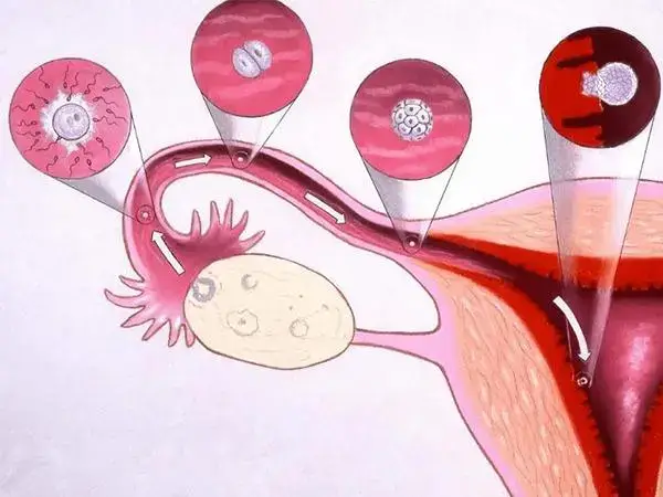 卵巢囊肿对试管婴儿的影响有哪些