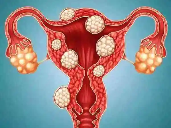 输卵管堵塞是不是只能做试管婴儿