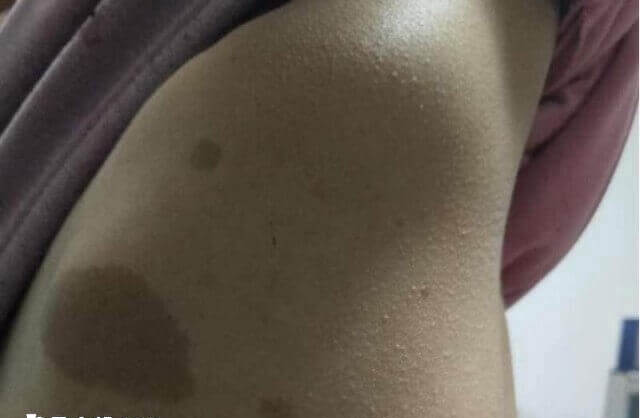 神经纤维瘤可不可以做试管婴儿