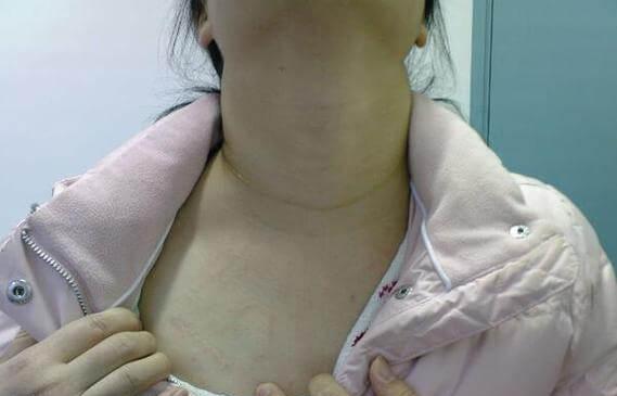 三代试管婴儿能不能筛查出甲状腺癌