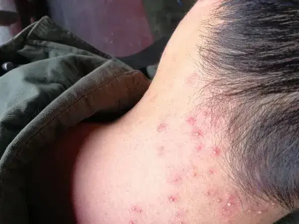 一岁宝宝得毛囊炎的原因是什么
