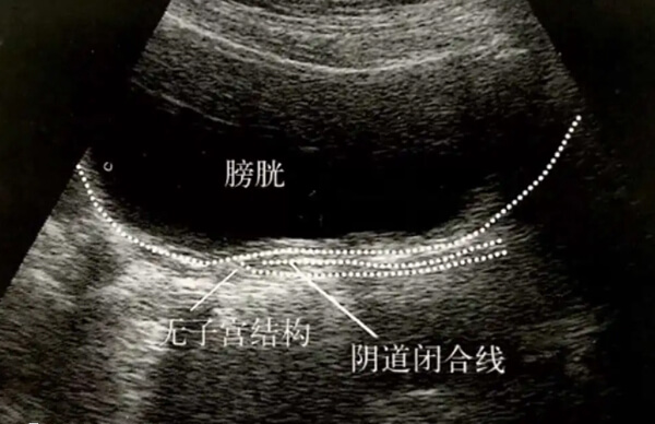 没有子宫的女人想怀孕生孩子要怎么办