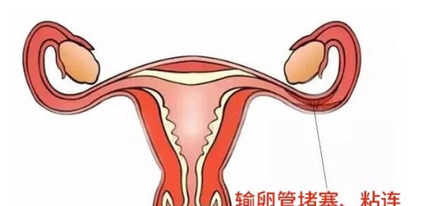 输卵管粘连宫内孕的几率是多少