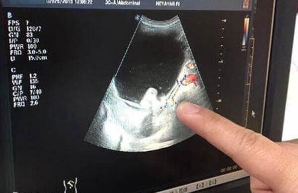 卵巢畸胎瘤能不能做试管婴儿