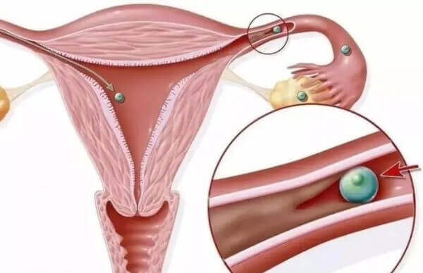 女性输卵管积水能不能做试管婴儿
