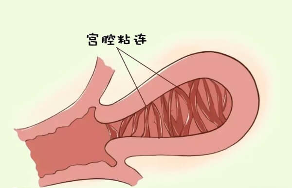 什么原因会导致宫腔粘连