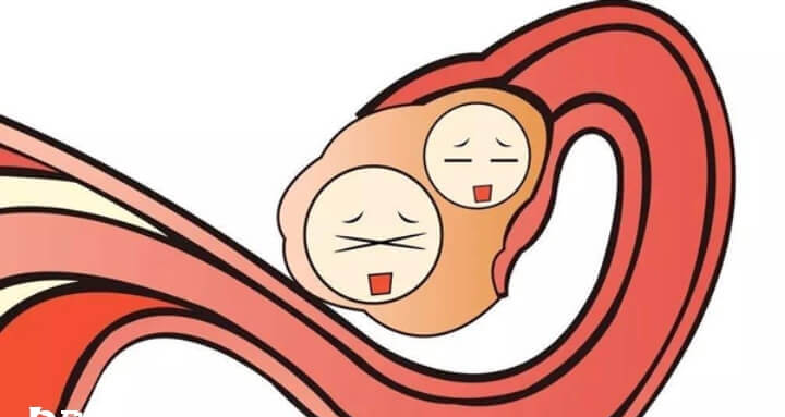 女性排卵障碍做试管婴儿定什么方案好