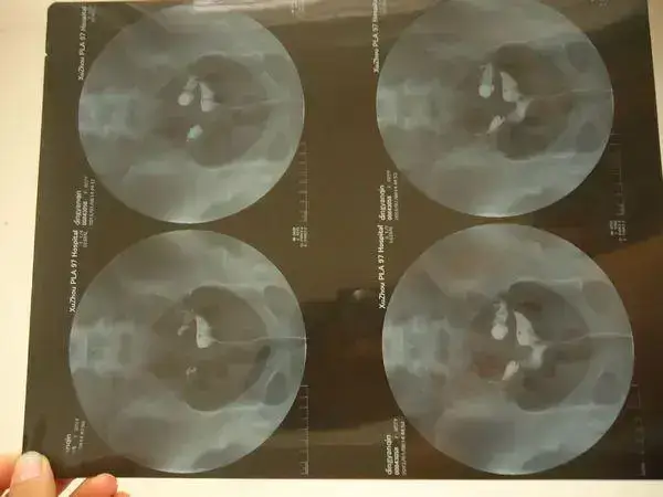 输卵管积水做试管婴儿成功率是多少