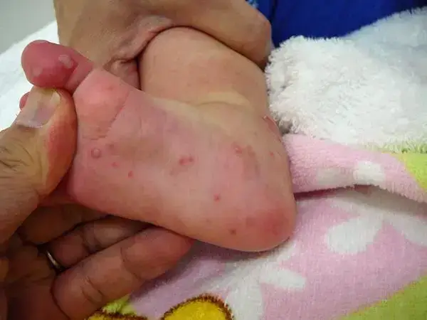 孩子长水痘有哪些注意事项
