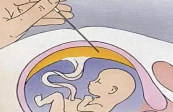 哪些人不能做羊水穿刺