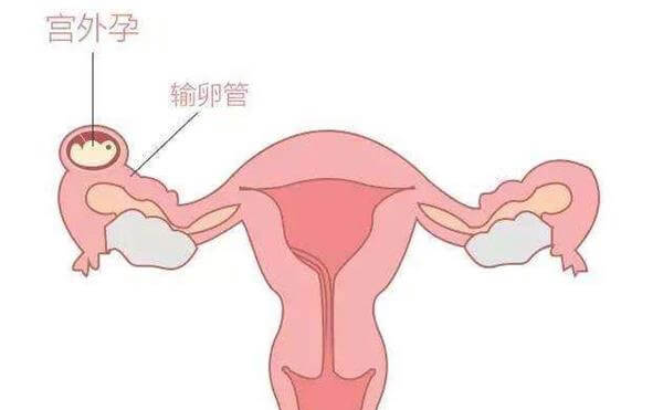 宫外孕有没有出血的症状