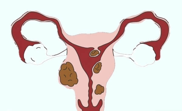 子宫肌瘤形成的原因是什么