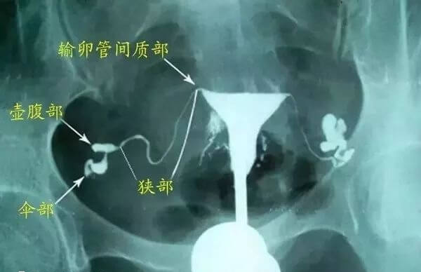 检测输卵管是否堵塞检查项目有哪些