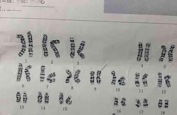 胚胎染色体16三体是怎么回事