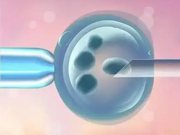 弓形子宫做试管婴儿是否要做宫腔镜