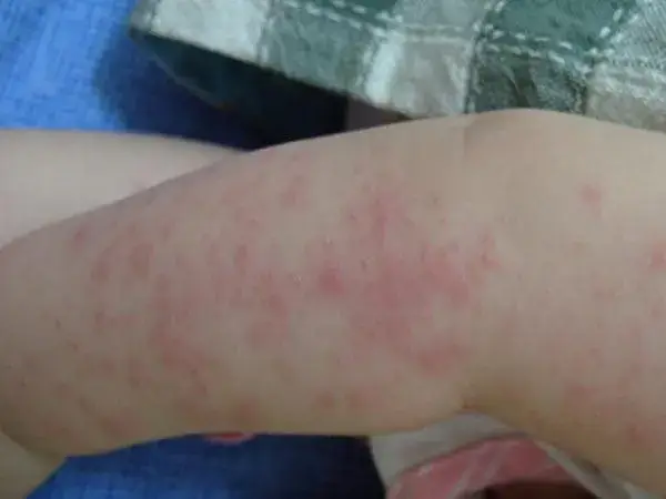宝宝出现湿疹的原因有哪些