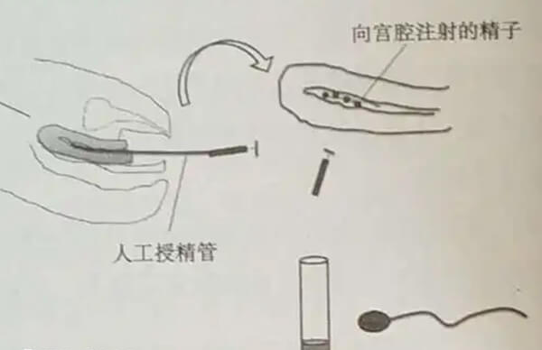人工授精是怎么做的