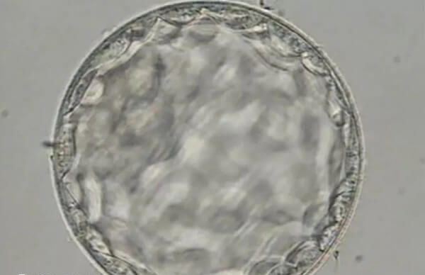 胚胎16三体是不是精子的问题