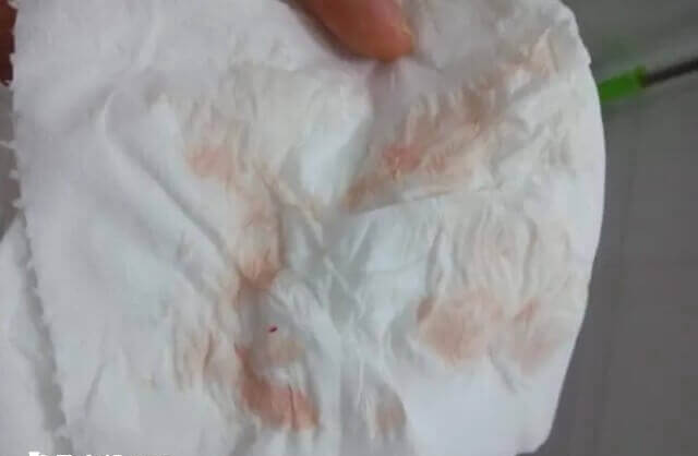 试管移植后翻倍正常却出血咋回事